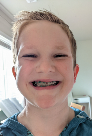 Picture of a boy smiling with braces